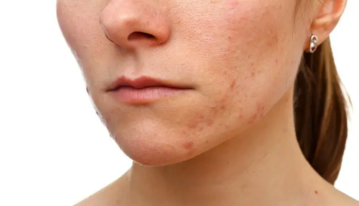 acne on woman face