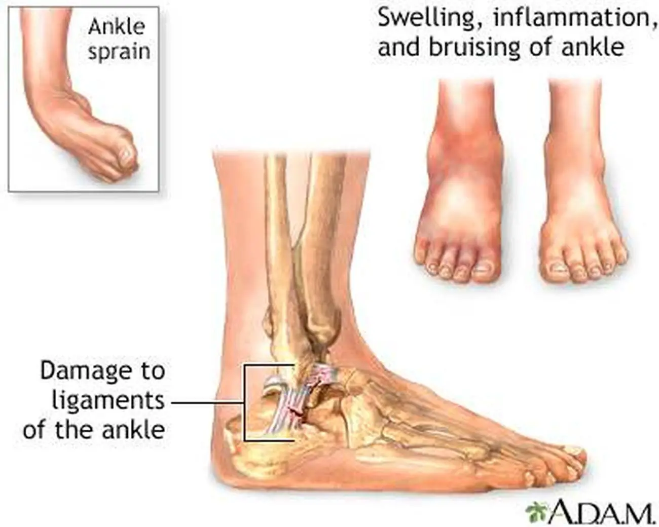 Pictures Of AnkleHealthiack