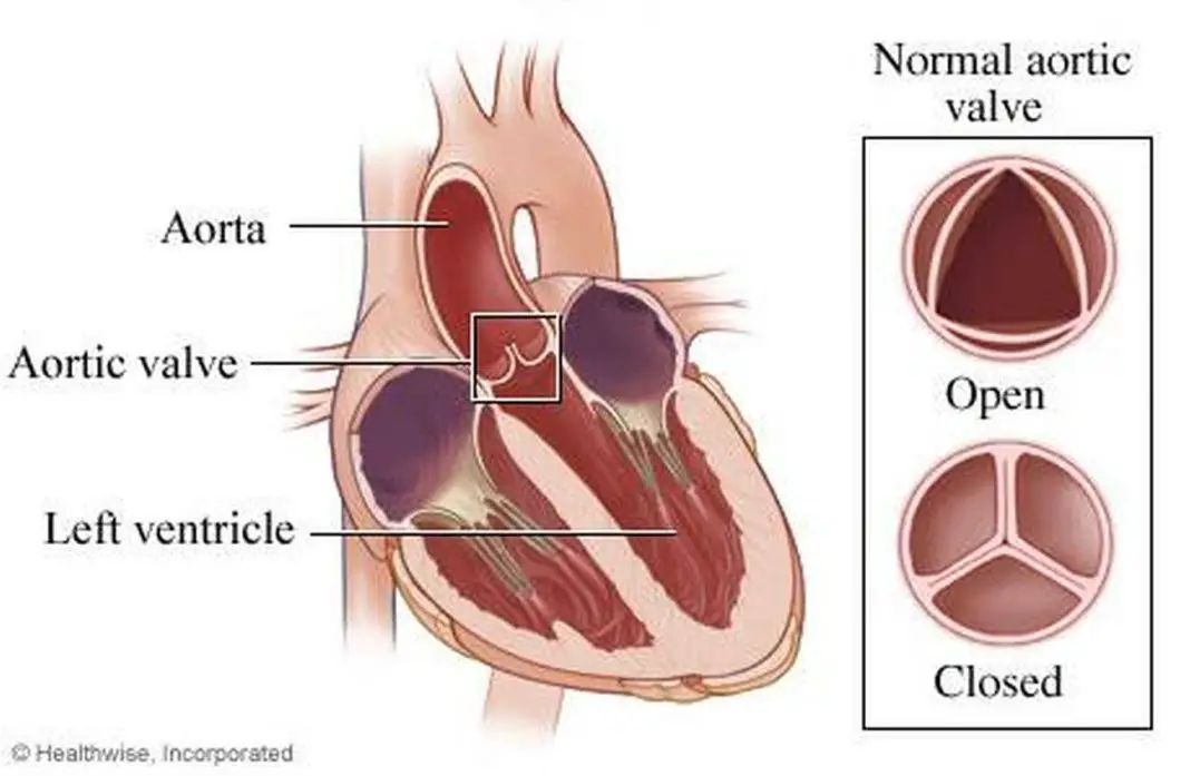 Pictures Of Aortic Valve