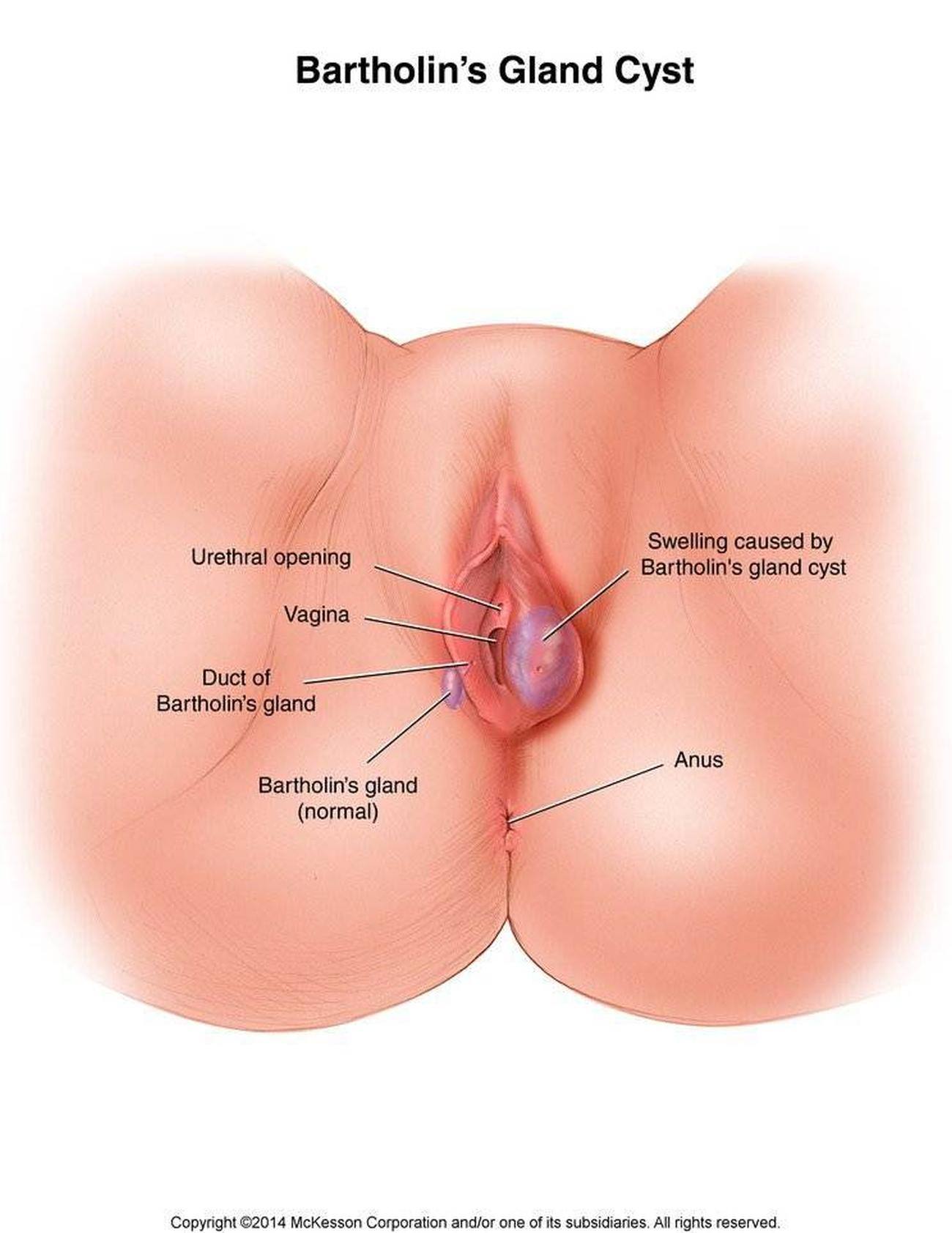 Vulva pustule treatment