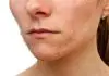 Different Acne Scar Treatment Options