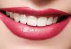 Reinvent Your Smile with Porcelain Veneers