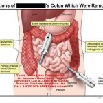 Colon diagram