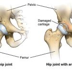Hip diagram