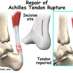 Pictures Of Achilles Tendon