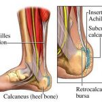 Pictures Of Achilles Tendon