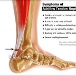 Pictures Of Achilles Tendon