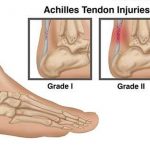 Pictures Of Achilles Tendon