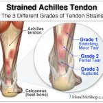 Pictures Of Achilles Tendon