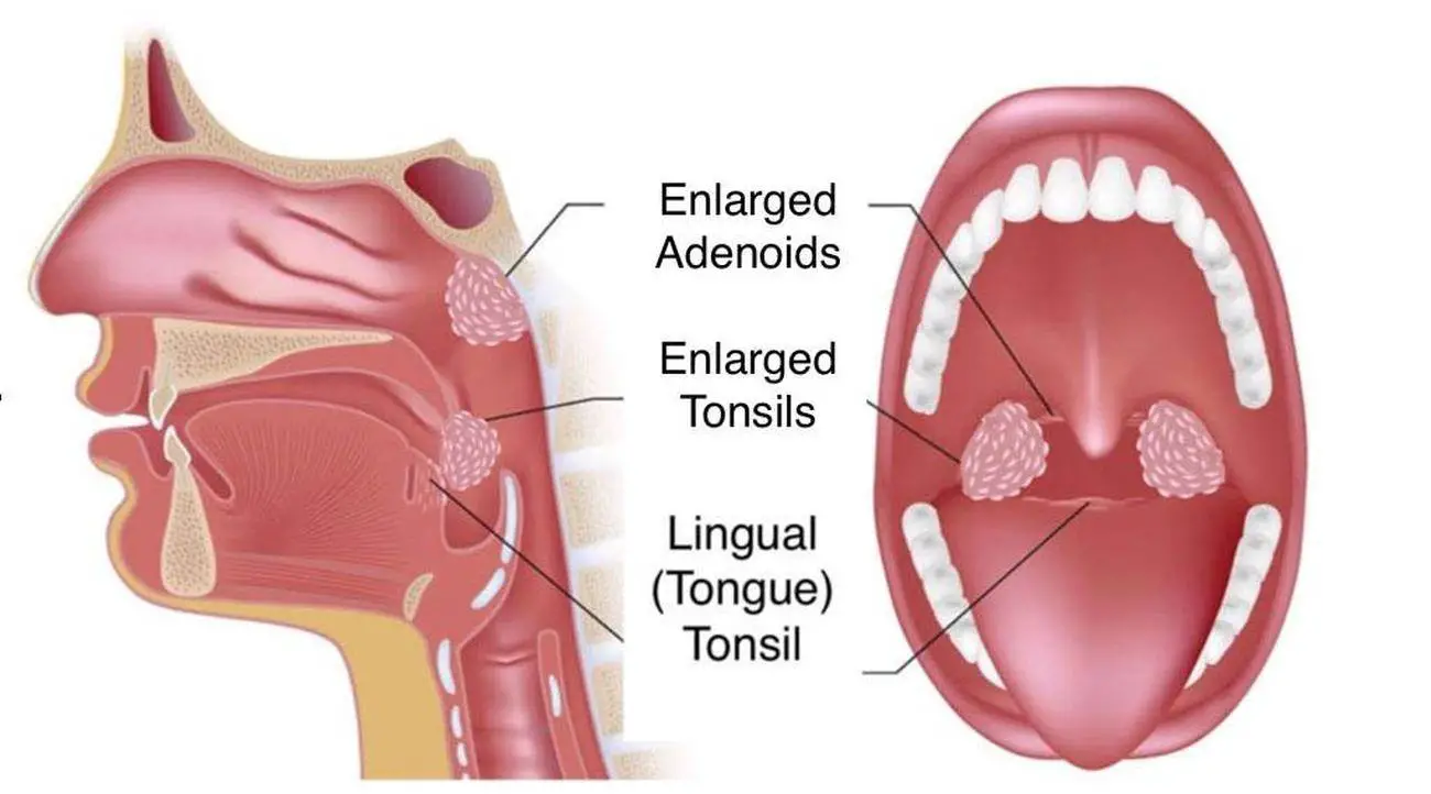 Pictures Of Adenoids