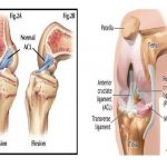 Pictures Of Anterior Cruciate Ligament