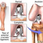 Pictures Of Anterior Cruciate Ligament