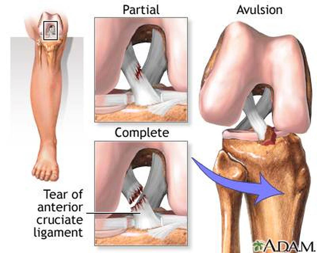 Pictures Of Anterior Cruciate Ligament