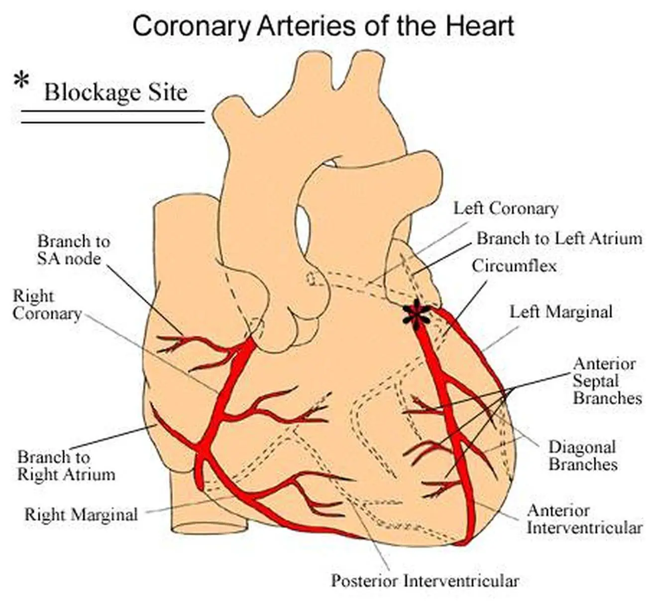 Pictures Of Anterior Interventricular Artery