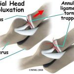 Pictures Of Anular Ligament Of The Radius