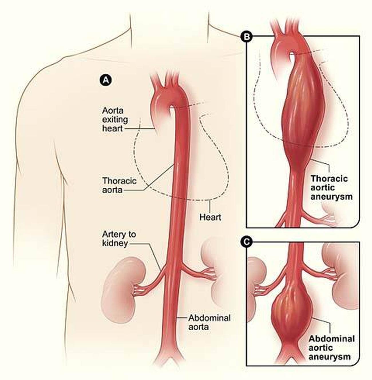 Pictures Of Aorta