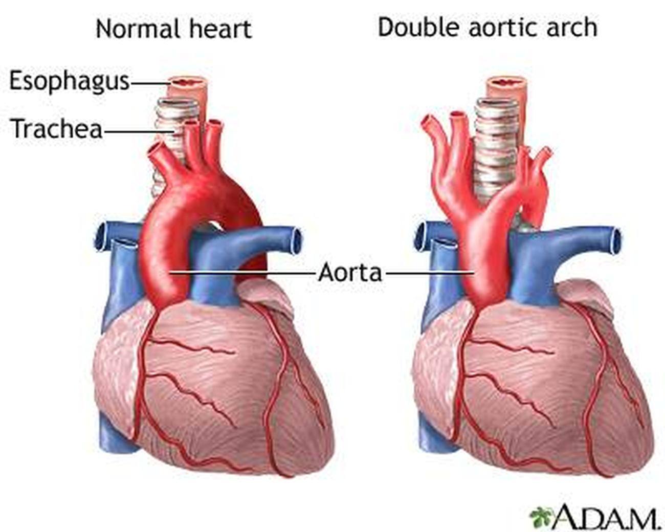 aortic arch picture