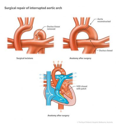 Pictures Of Aortic Arch