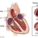 Pictures Of Aortic Valve
