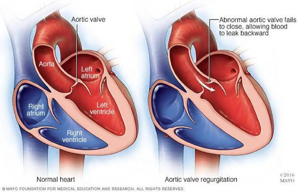 pictures-of-aortic-valve