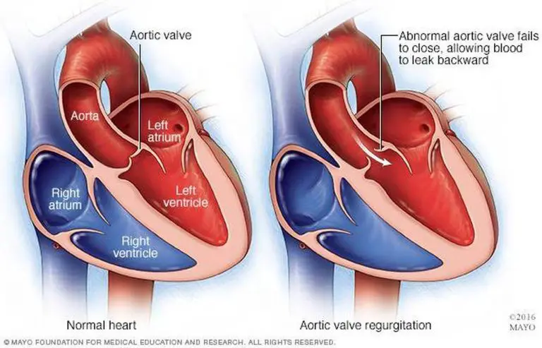 Pictures Of Aortic Valve