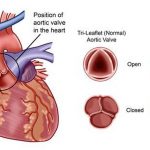 Pictures Of Aortic Valve