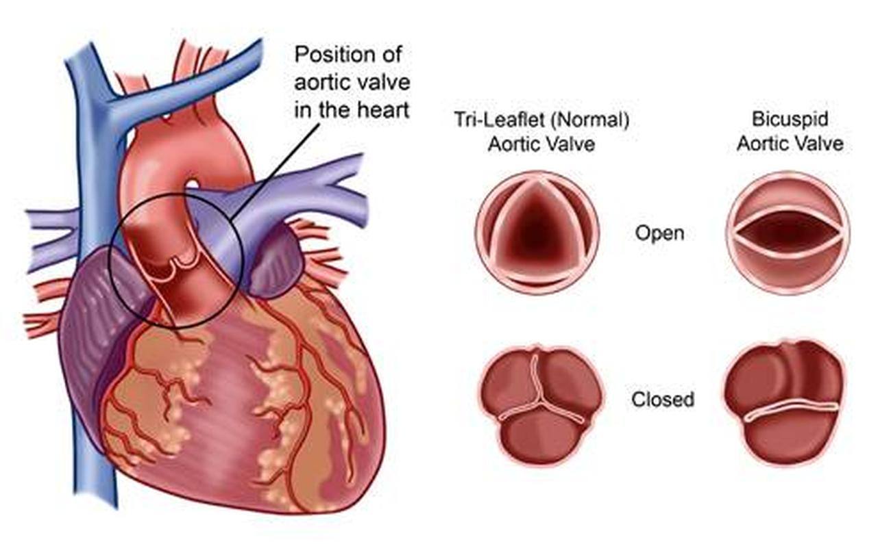 Bicuspid aortic valve surgery