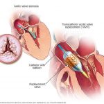 Pictures Of Aortic Valve
