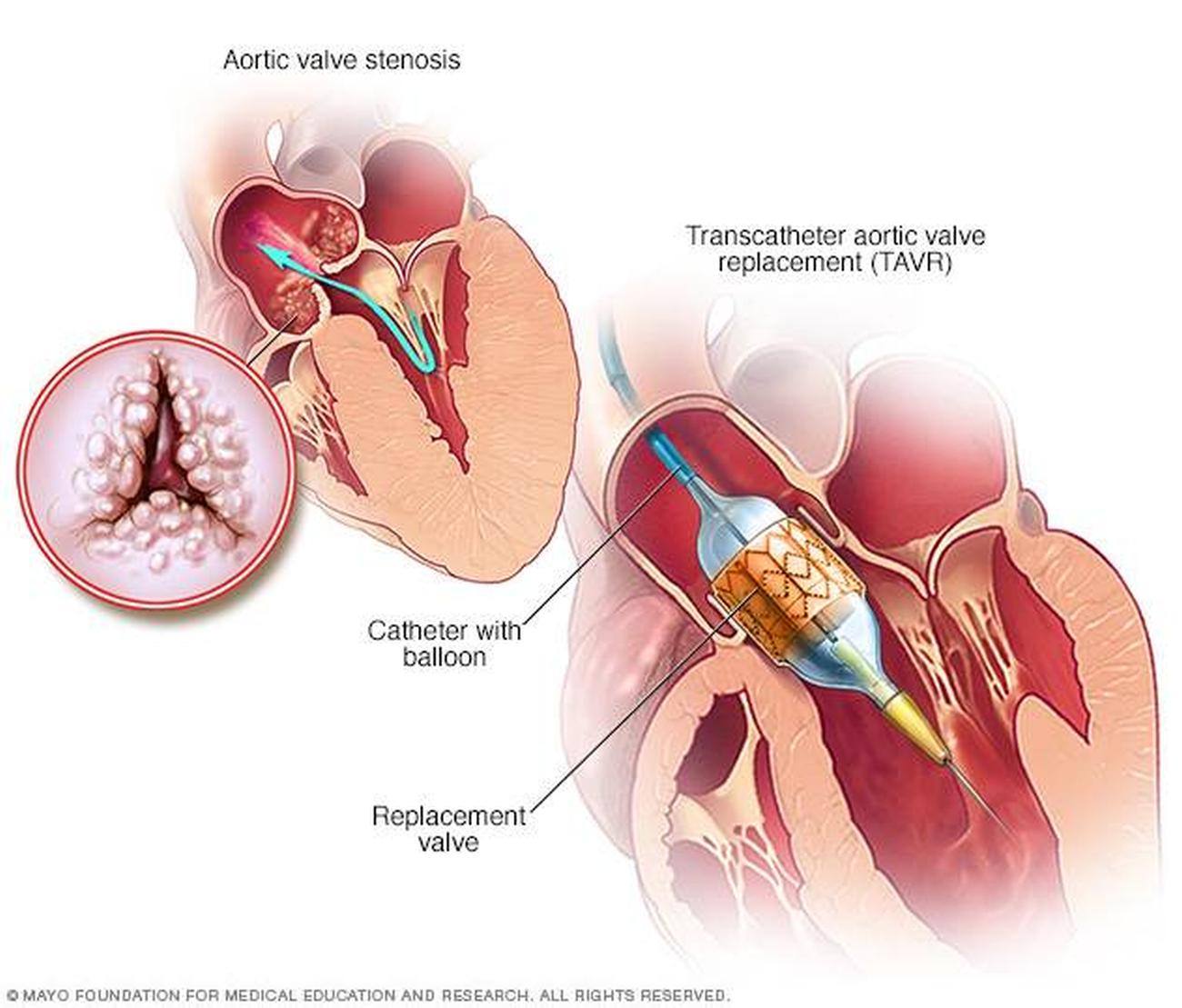 Pictures Of Aortic Valve
