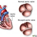 Pictures Of Aortic Valve