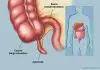 Pictures Of Appendix
