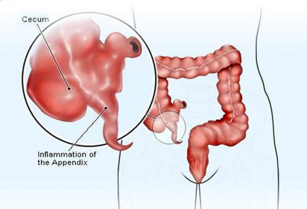 Pictures Of Appendix