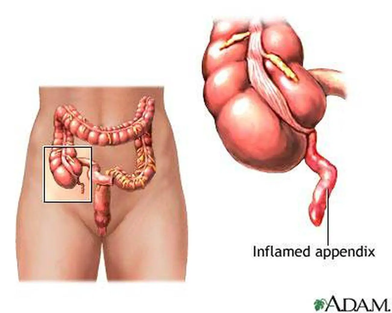 Pictures Of Appendix