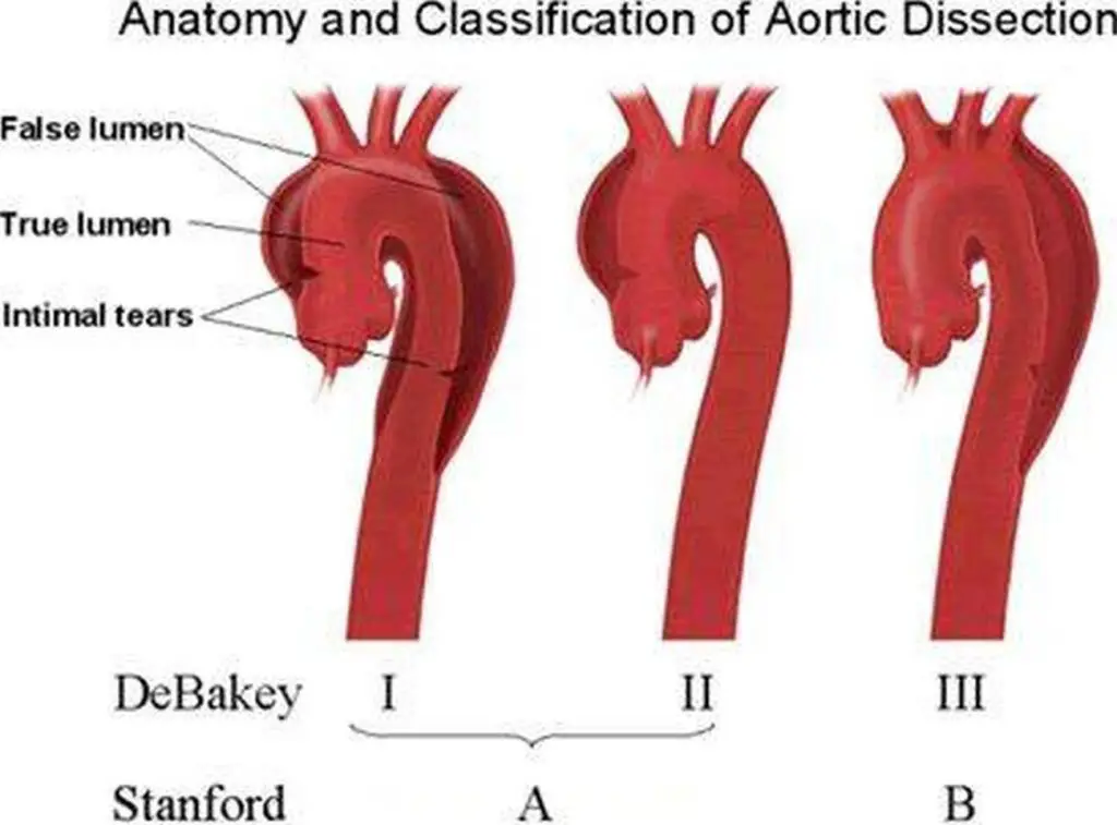 Pictures Of Ascending Aorta