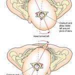 Pictures Of Atlas Axis Joint