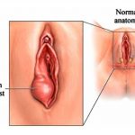 Pictures Of Bartholin’s Gland