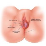 Pictures Of Bartholin’s Gland