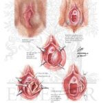 Pictures Of Bartholin’s Gland