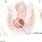 Pictures Of Bartholin’s Gland