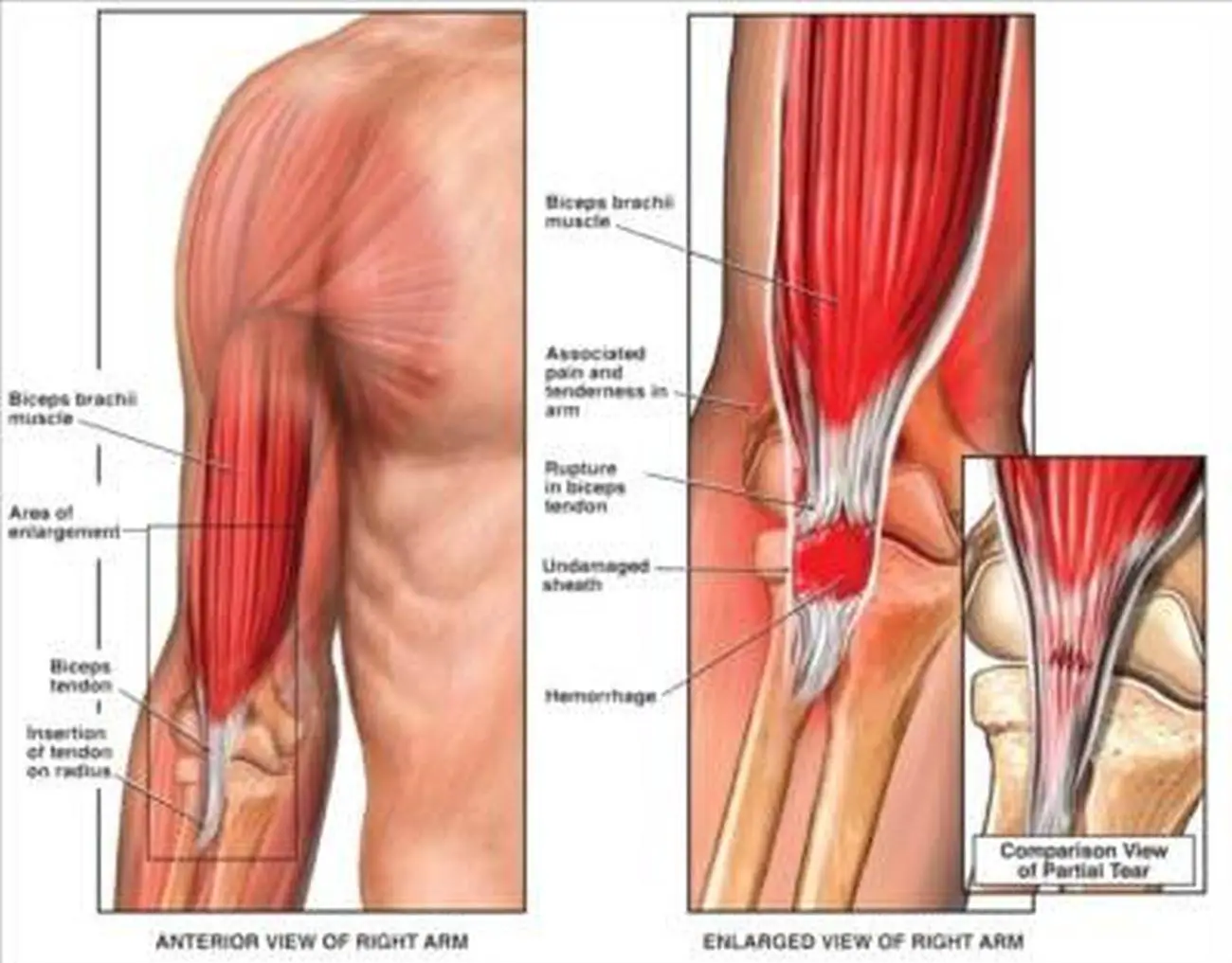 Pictures Of Biceps Brachii Tendons