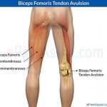 Pictures Of Biceps Femoris Tendons