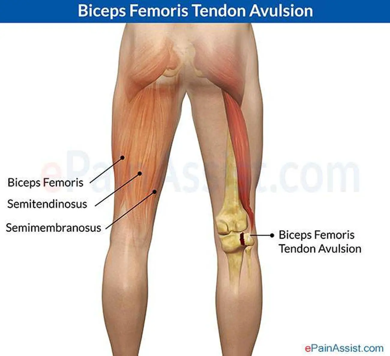 Pictures Of Biceps Femoris Tendons