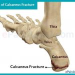 Pictures Of Calcaneus