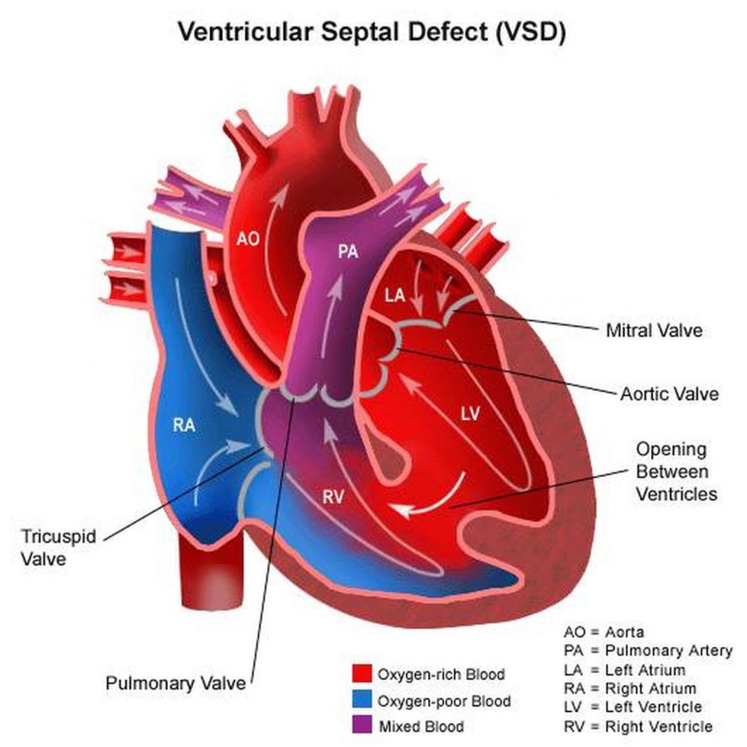 VSD Heart