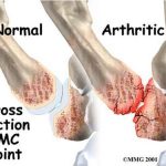 Pictures Of Carpometacarpal Joint Of The Thumb