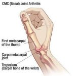 Pictures Of Carpometacarpal Joints