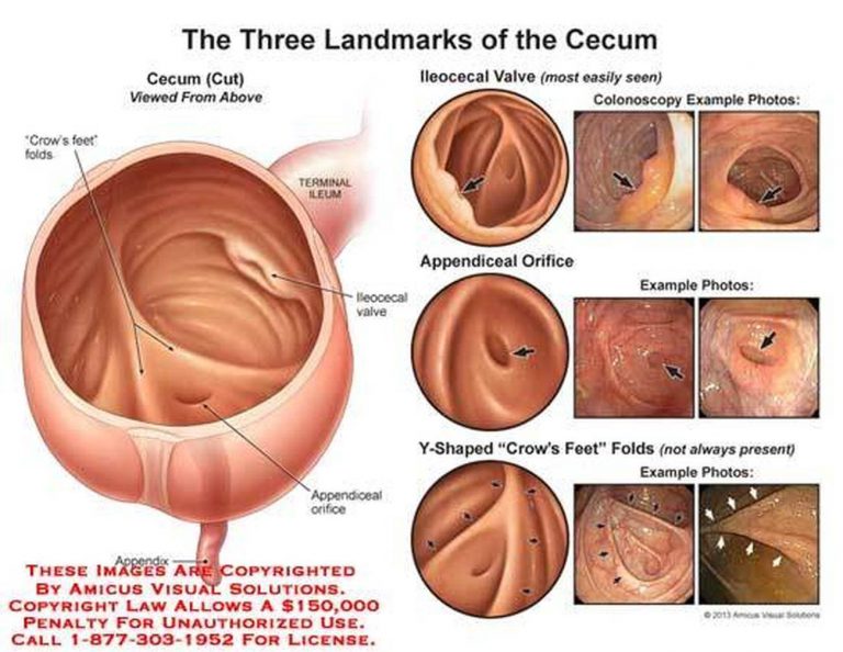 Pictures Of Cecum