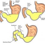 Pictures Of Chyme