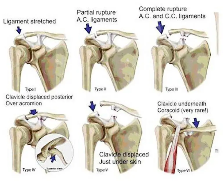 pictures-of-acromioclavicular-joint