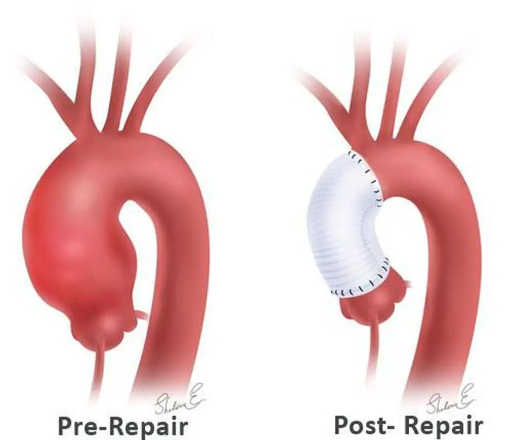 Pictures Of Ascending Aorta